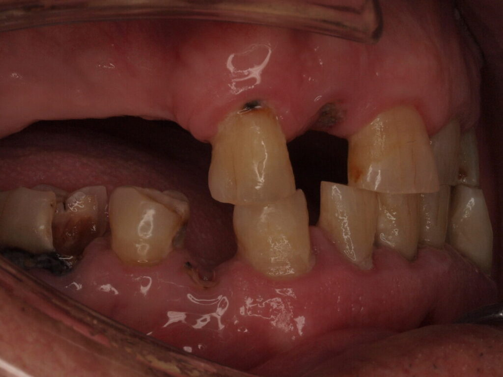 Lateral derecha antes del tratamiento: tramos sin dientes en ambas arcadas y caries en un molar inferior