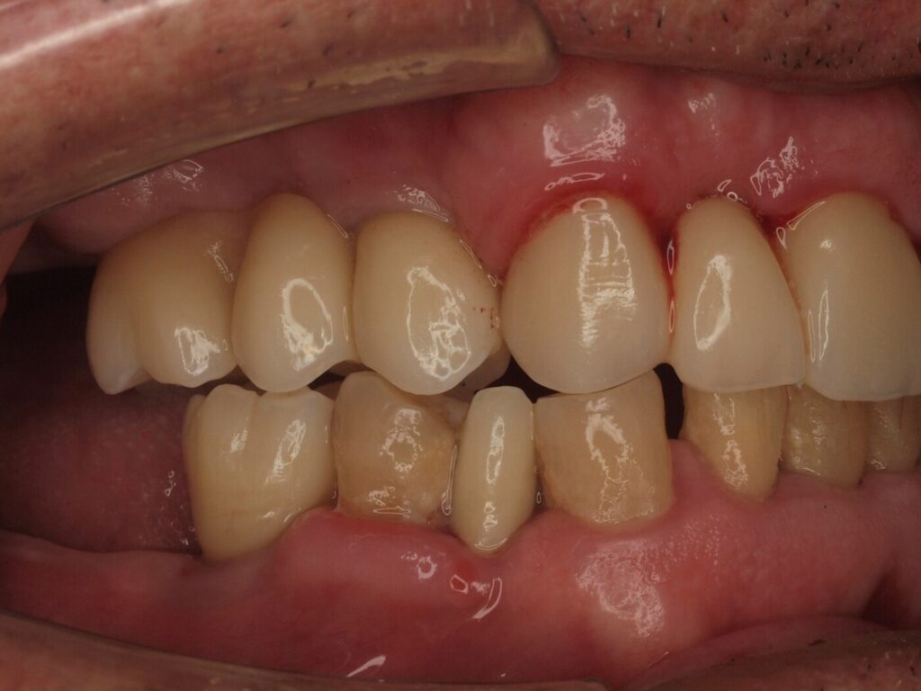 Lateral derecha después: coronas sobre implantes de premolar a segundo molar