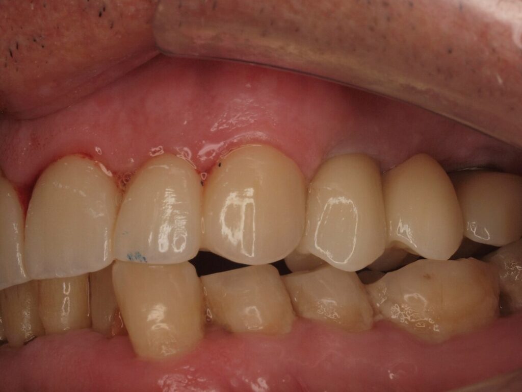 Lateral izquierda después: sector posterior con coronas sobre implantes y masticación recuperada