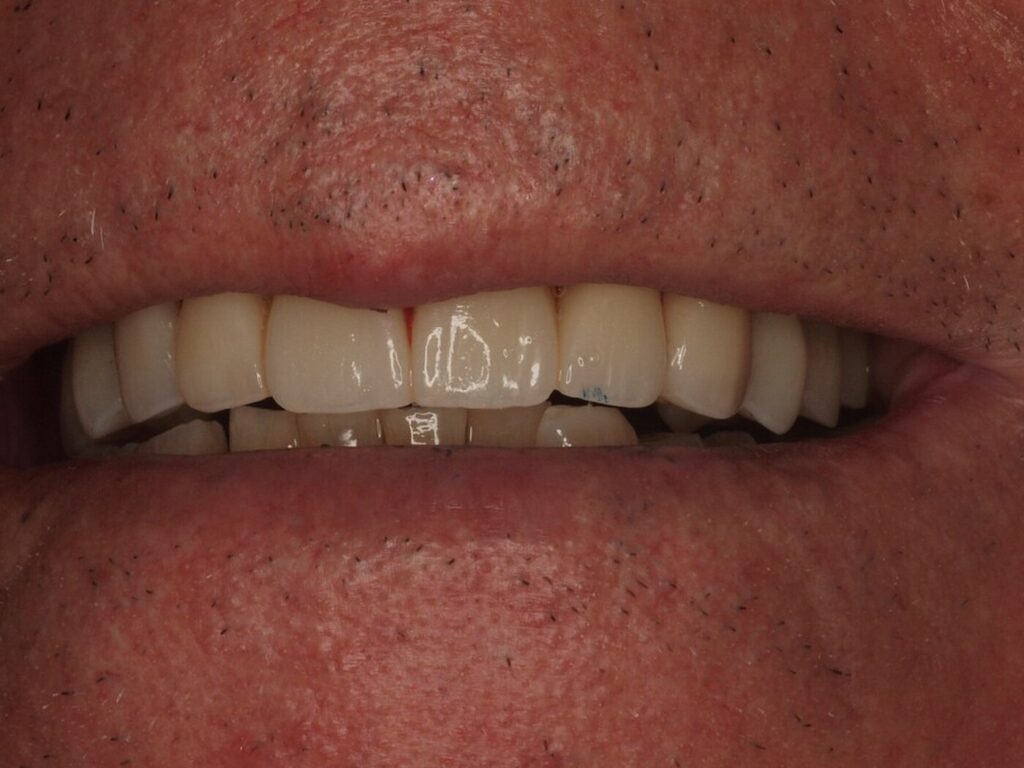 Sonrisa final de Antonio tras la rehabilitación con implantes en Clínica Dental Such, Valencia