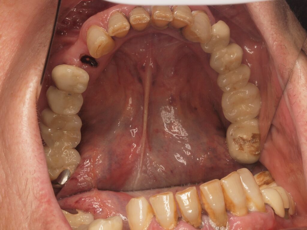 All-on-6 con carga inmediata en Valencia: el caso de Pilar 5 Arcada inferior antes del All-on-6: dientes desgastados, manchas y espacios entre piezas