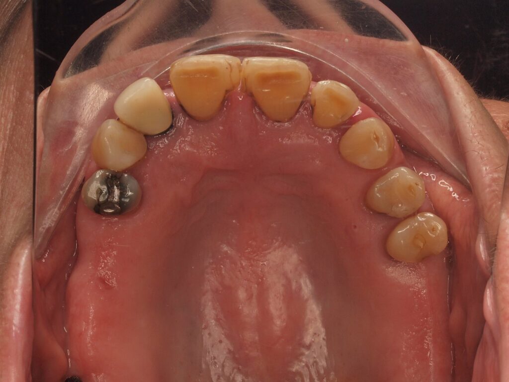 All-on-6 con carga inmediata en Valencia: el caso de Pilar 3 Arcada superior antes del All-on-6: dientes desgastados, con manchas y huecos en la zona posterior