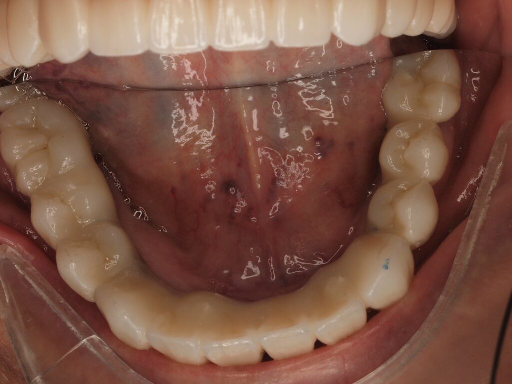 All-on-6 con carga inmediata en Valencia: el caso de Pilar 6 Arcada inferior con prótesis fija All-on-6 sobre implantes y carga inmediata, Valencia