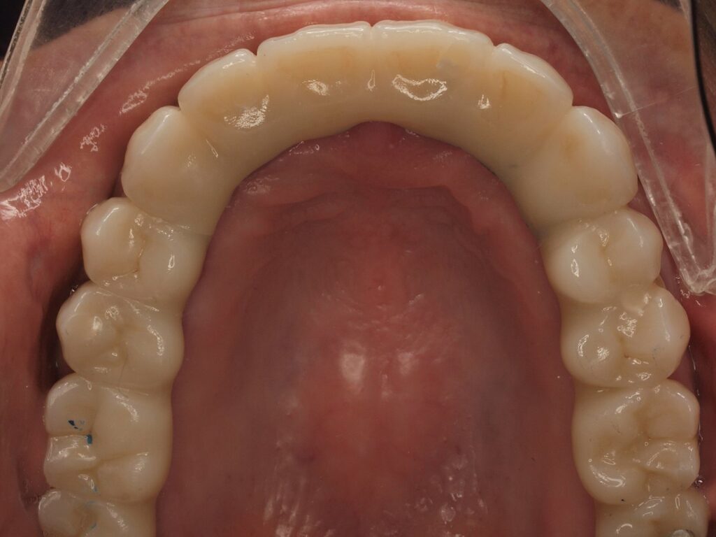 All-on-6 con carga inmediata en Valencia: el caso de Pilar 4 Arcada superior tras el All-on-6 con carga inmediata: prótesis fija de arcada completa sobre implantes
