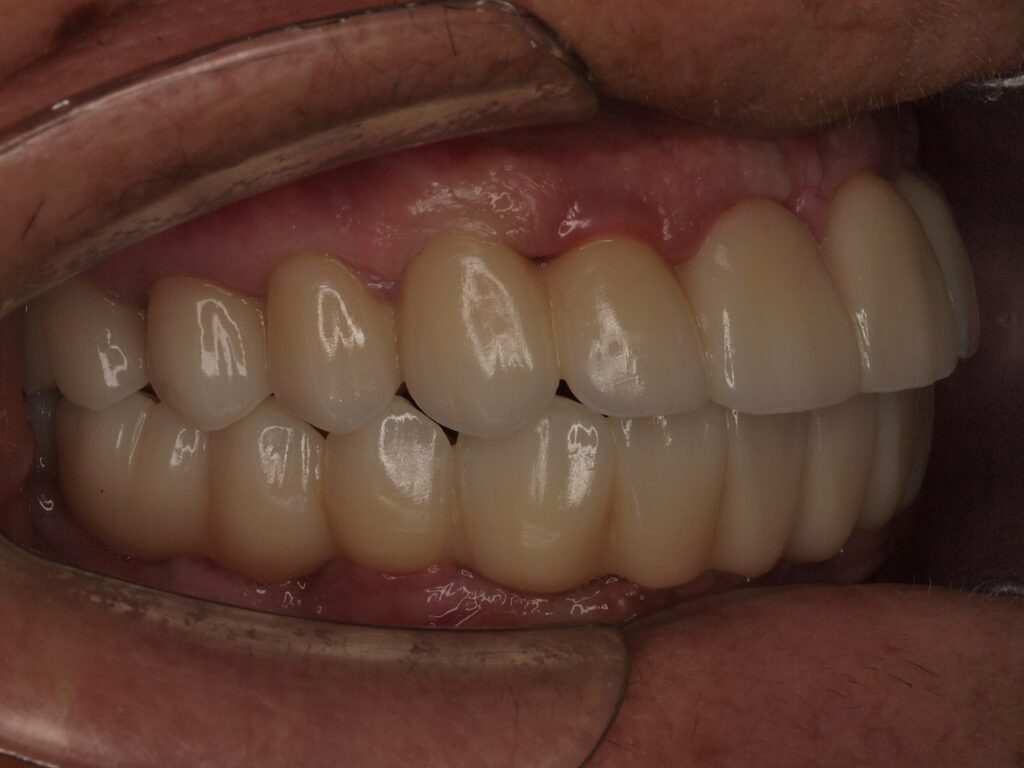 All-on-6 con carga inmediata en Valencia: el caso de Pilar 8 Lateral derecho con la prótesis fija All-on-6 superior e inferior, en Clínica Dental Such, Valencia