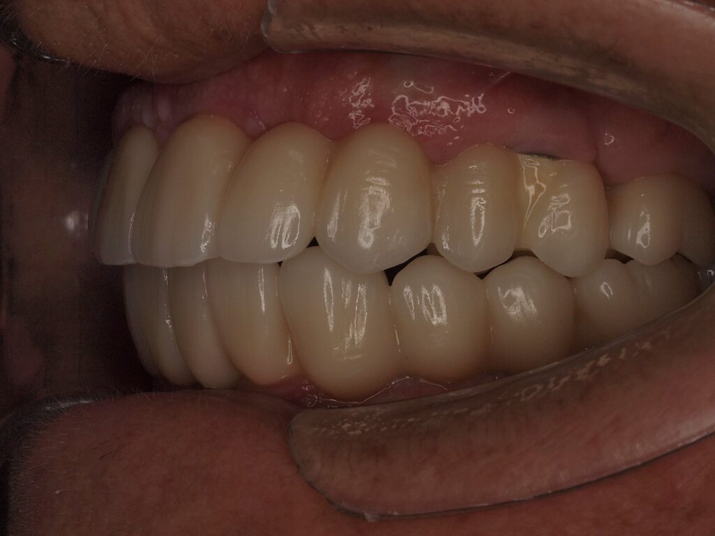 All-on-6 con carga inmediata en Valencia: el caso de Pilar 10 Lateral izquierdo con prótesis fija sobre implantes All-on-6 en ambas arcadas