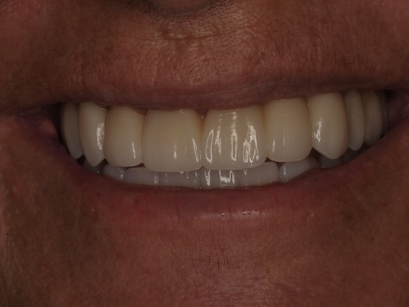 Sonrisa de Pilar tras su All-on-6 con carga inmediata en Clínica Dental Such, Valencia