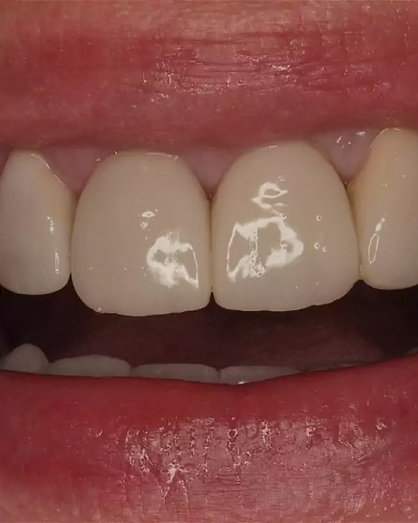 Sonrisa de Esther tras sus carillas superiores e inferiores, caso real de la clínica