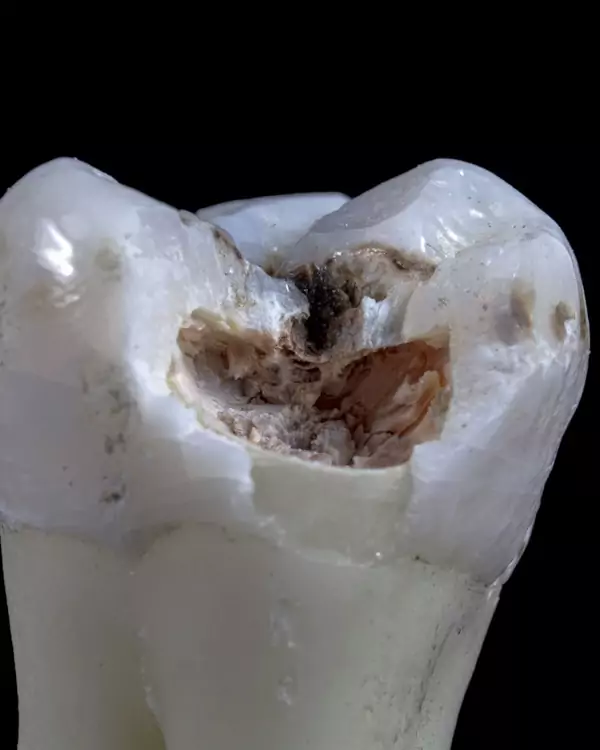 Muela con caries antes de hacer un empaste