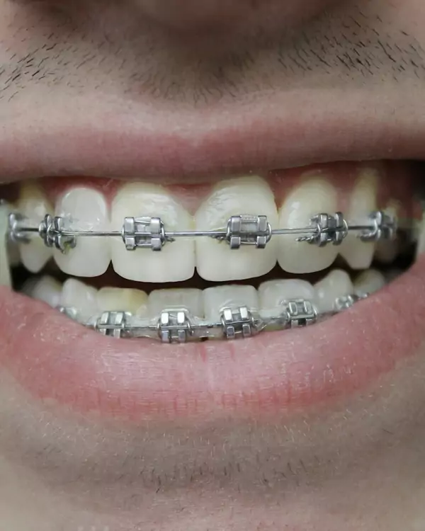 Sonrisa con brackets metálicos