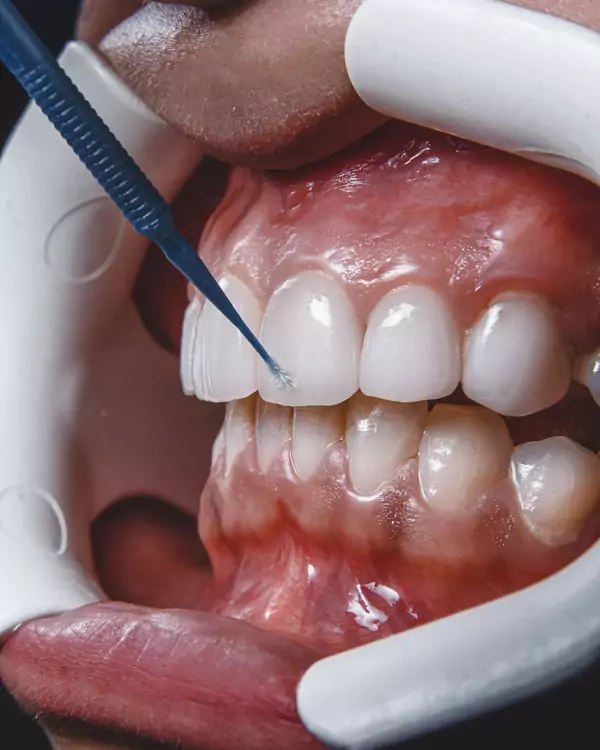 Sonda periodontal midiendo la encía