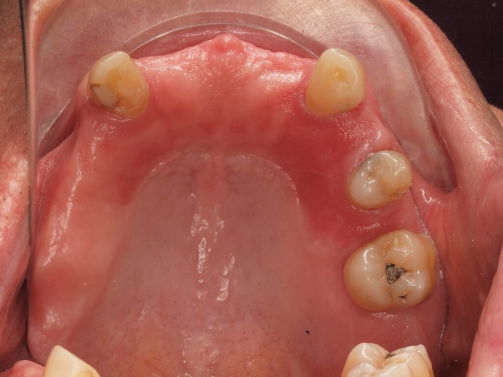 Puentes sobre implantes, circonio y carillas: el caso de Eusebio 5 Arcada superior antes de la rehabilitación: pocos dientes y grandes espacios sin dientes