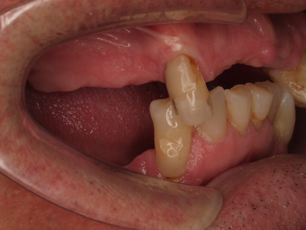 Puentes sobre implantes, circonio y carillas: el caso de Eusebio 9 Lateral derecho antes del tratamiento: espacios sin dientes y piezas inclinadas hacia los huecos