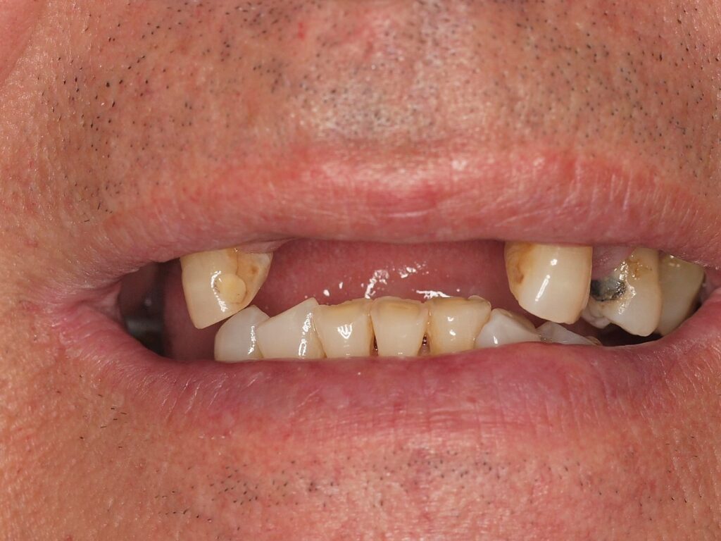 Puentes sobre implantes, circonio y carillas: el caso de Eusebio 3 Sonrisa antes del tratamiento, con huecos visibles entre los dientes