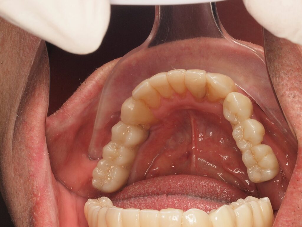 Puentes sobre implantes, circonio y carillas: el caso de Eusebio 8 Arcada inferior con puentes sobre implantes en 34-36 y 44-46 y carillas de 33 a 43, Valencia
