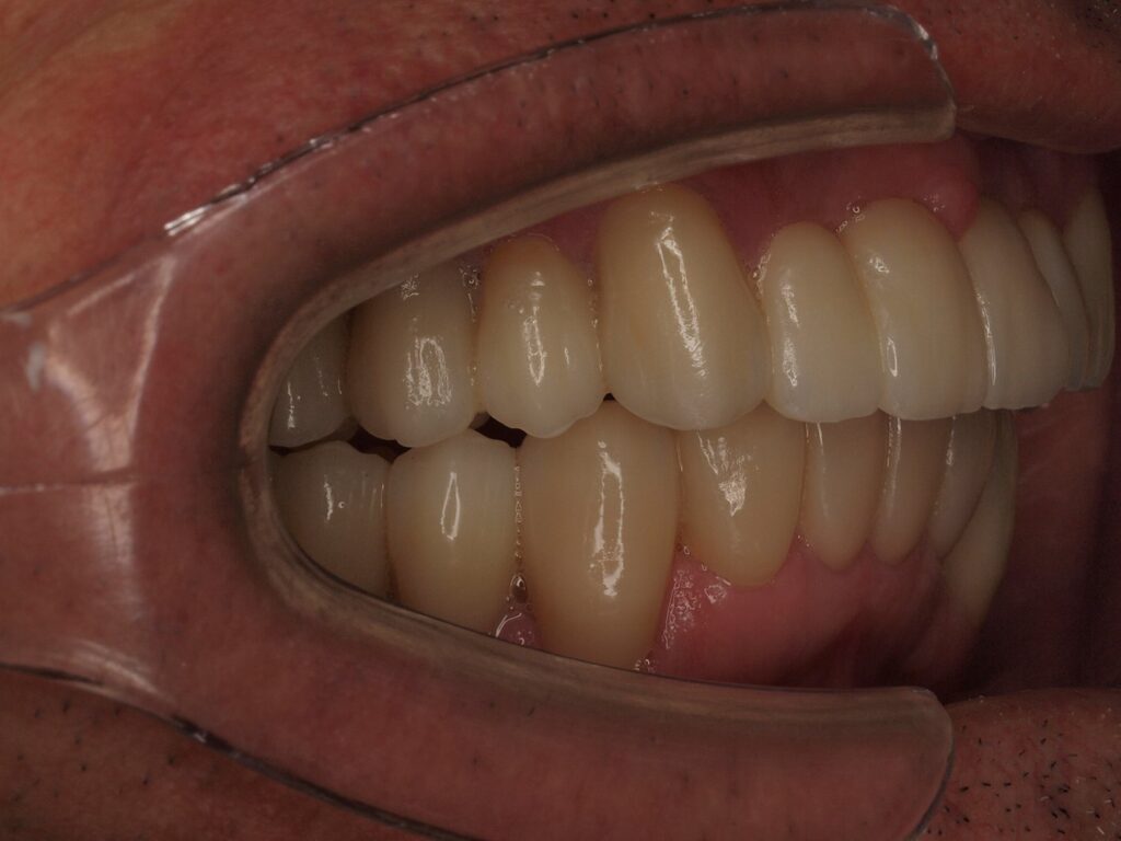 Puentes sobre implantes, circonio y carillas: el caso de Eusebio 10 Lateral derecho después: puentes sobre implantes en 14-15 y 44-46 con la mordida completa