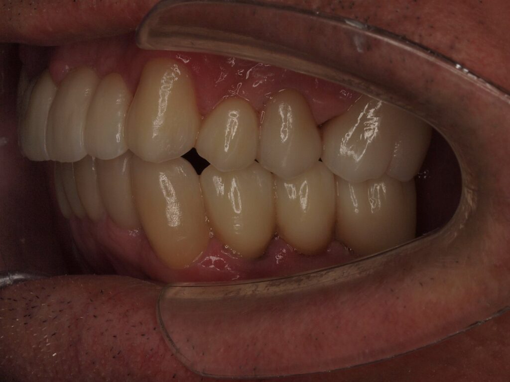 Puentes sobre implantes, circonio y carillas: el caso de Eusebio 12 Lateral izquierdo después: puente sobre implantes en 34-36 y puente de circonio superior