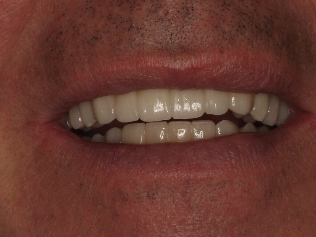 Puentes sobre implantes, circonio y carillas: el caso de Eusebio 4 Sonrisa completa tras la rehabilitación oral con puentes sobre implantes y carillas en Valencia