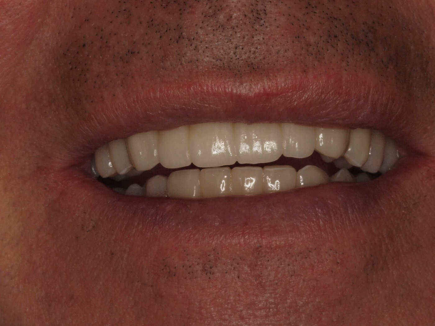 Sonrisa completa tras la rehabilitación oral con puentes sobre implantes y carillas en Valencia