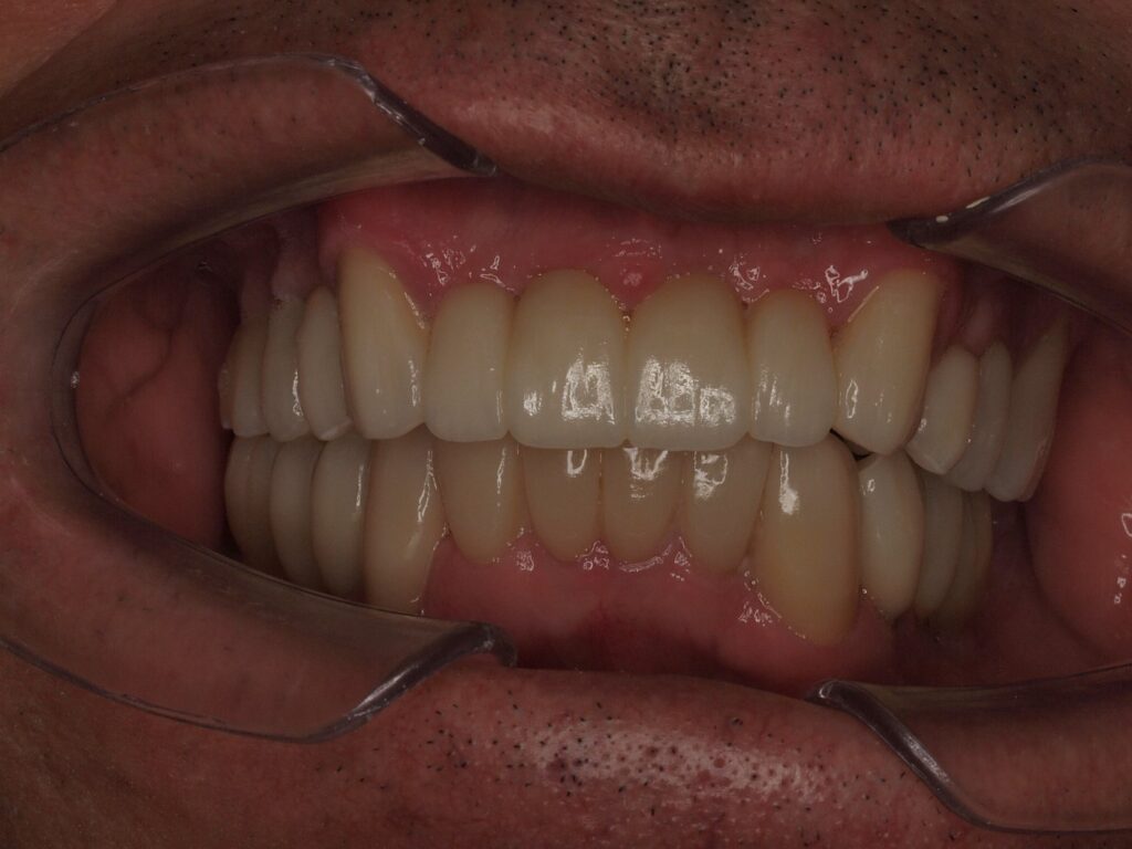 Vista frontal al morder tras la rehabilitación con puentes sobre implantes, circonio y carillas